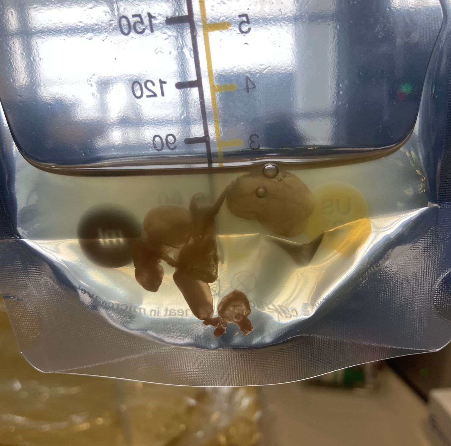 Coagulated colostrum.